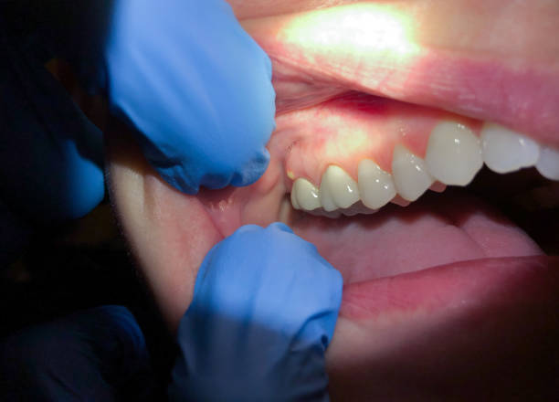 Best Emergency Root Canal Treatment in Lampasas, TX