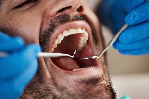 Best Emergency Tooth Extraction in Lampasas, TX